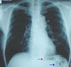 胸部Ｘ線写真の例