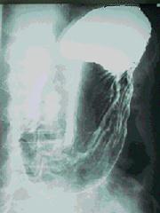 胃Ｘ線造影写真