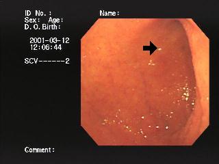 内視鏡写真の白い斑点