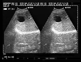 超音波断層画像の例（肝嚢胞）